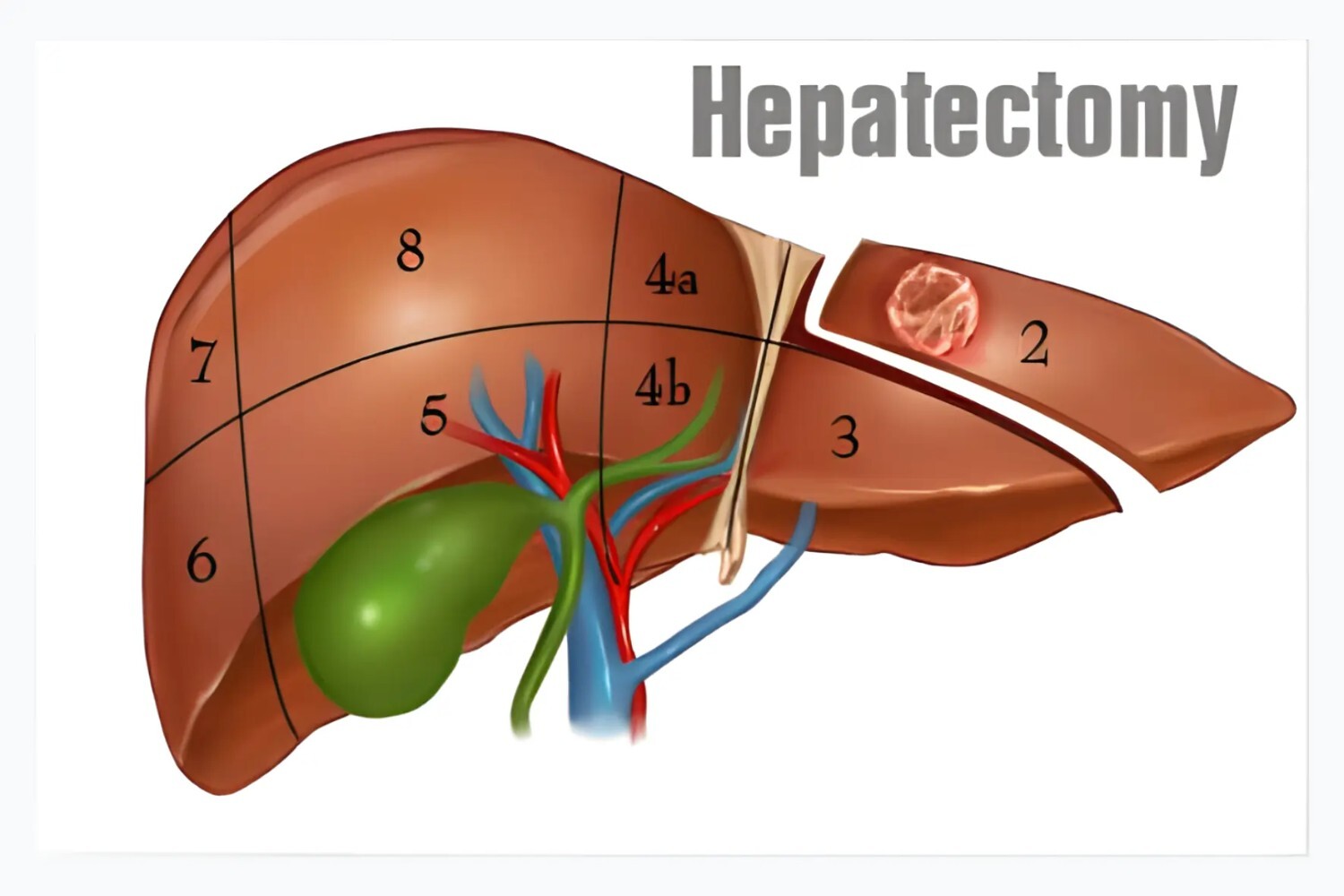 Hepatectomy / Liver Resection