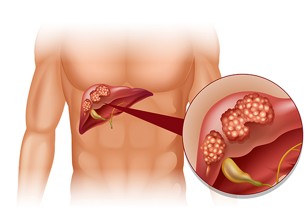 Liver Cancer Surgery