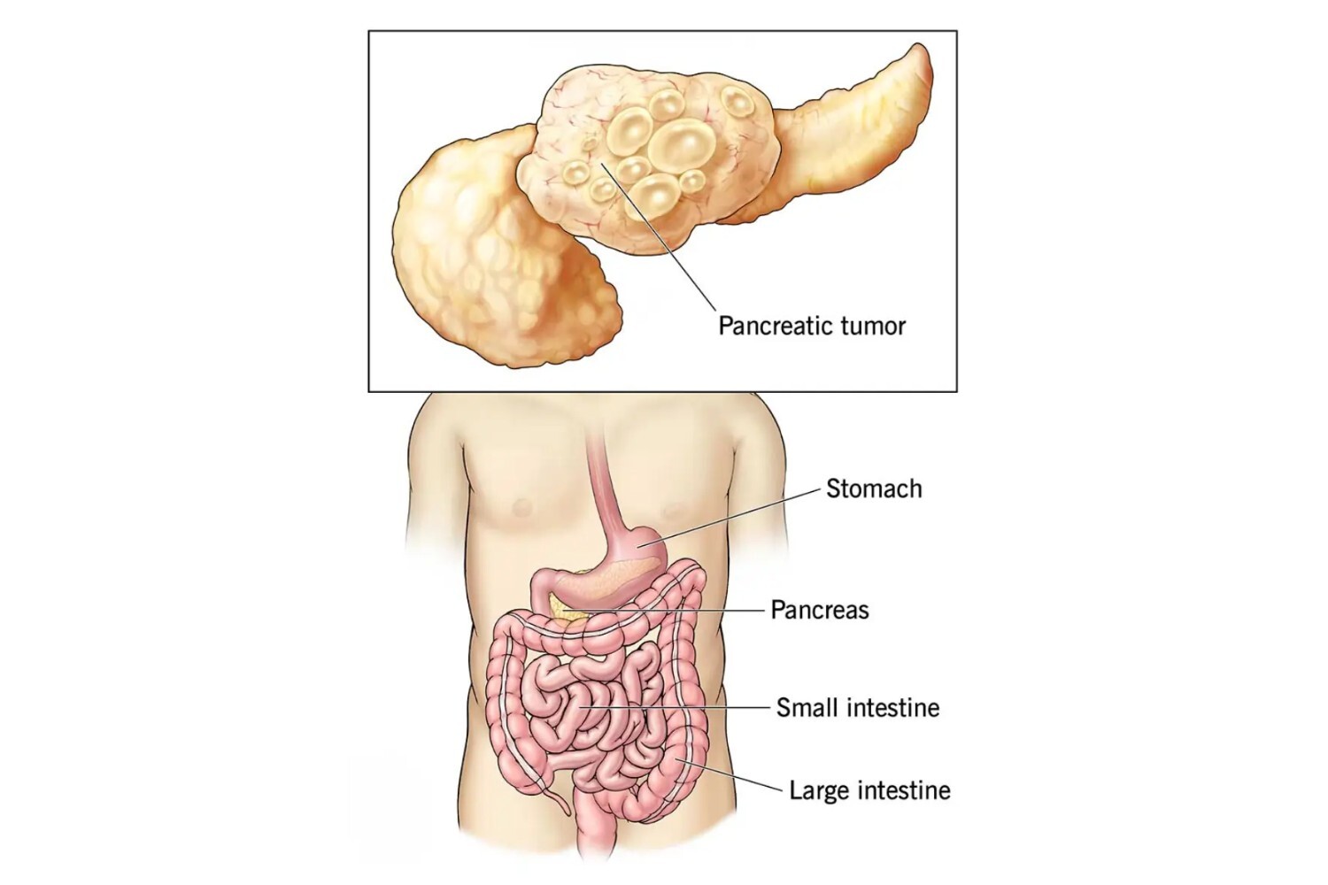 Pancreatic Surgery