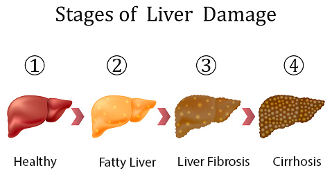 Indications For Liver Transplantation