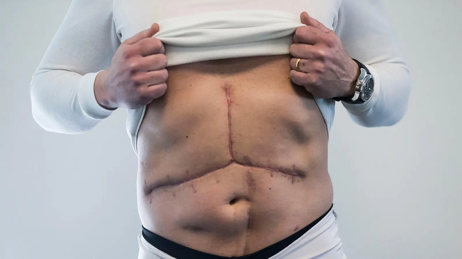Post Liver Transplant Post Liver Transplant